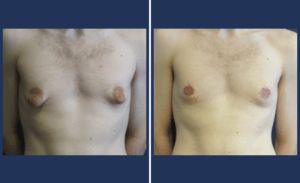 Male Breast Reduction #001, before and after photo