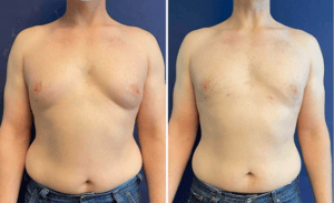 Male Breast Reduction #002, before and after photo