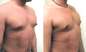 Male Breast Reduction #003, before and after photo