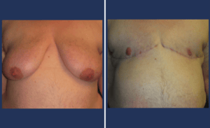 FTM Chest Masculinization Surgery #001, before and after photo