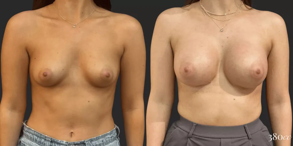 Breast Augmentation #002, before and after photo