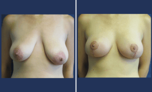 Breast Augmentation + Lift #001, before and after photo