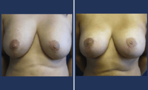 Breast Lift  #001, before and after photo