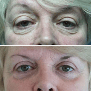 Eyelid Lift #001, before and after photo