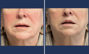 Lip Lift #001, before and after photo