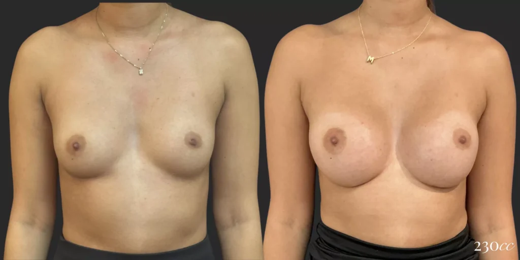Breast Augmentation #001, before and after photo