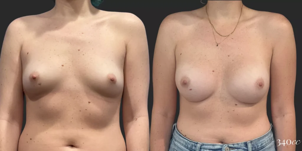 Breast Augmentation #003, before and after photo