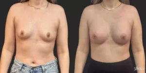 Breast Augmentation #004, before and after photo