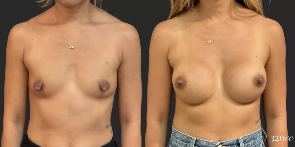 Breast Augmentation #005, before and after photo