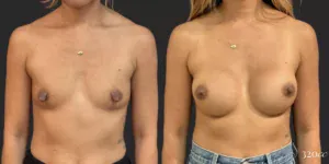 Breast Augmentation #005, before and after photo