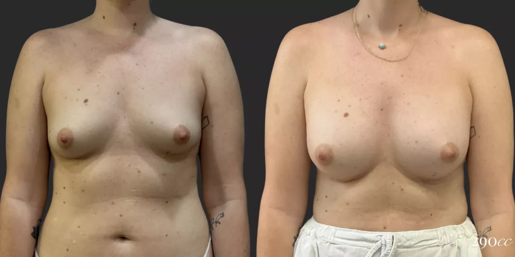 Breast Augmentation #006, before and after photo