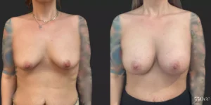 Breast Augmentation #007, before and after photo