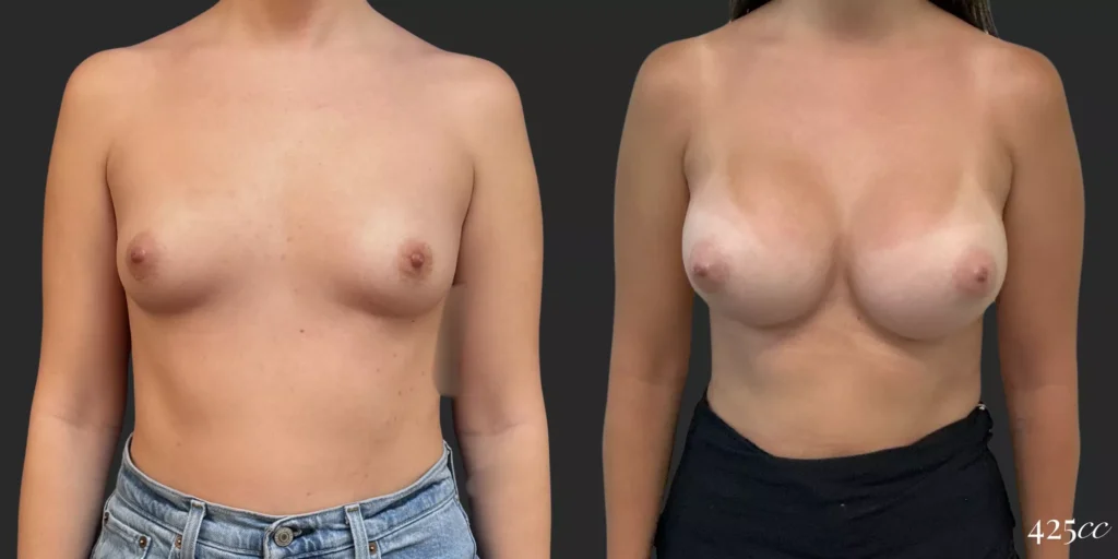 Breast Augmentation #008, before and after photo