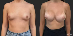 Breast Augmentation #008, before and after photo