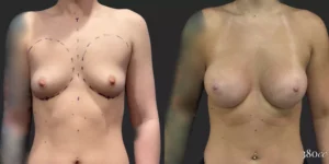 Breast Augmentation #009, before and after photo