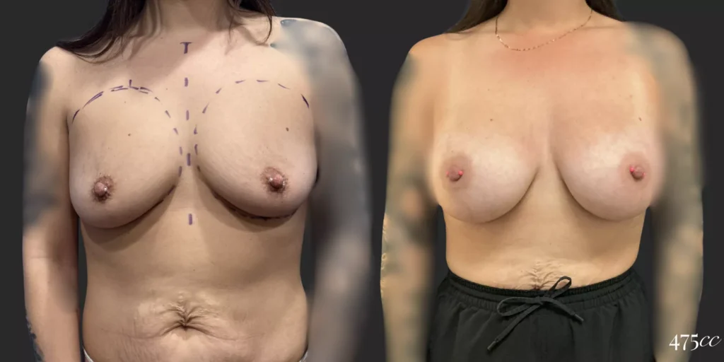 Breast Augmentation #010, before and after photo