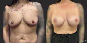 Breast Augmentation #010, before and after photo