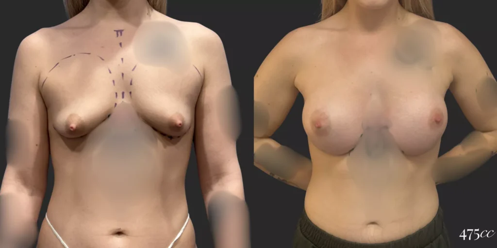 Breast Augmentation #011, before and after photo