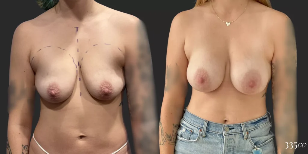 Breast Augmentation #012, before and after photo