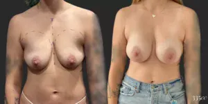 Breast Augmentation #012, before and after photo