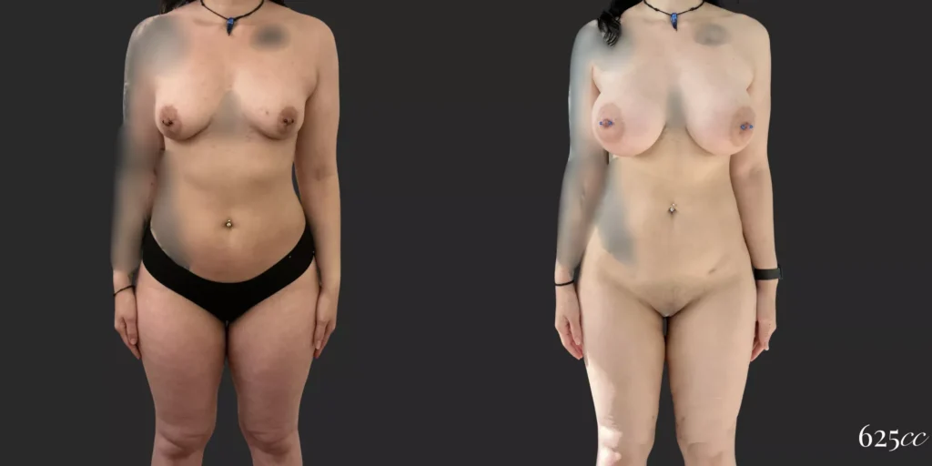 Breast Augmentation with 360 Lipo plus Lipo of Inner/Outer Thighs and Knees #013, before and after photo