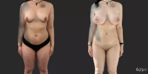 Breast Augmentation with 360 Lipo plus Lipo of Inner/Outer Thighs and Knees #013, before and after photo