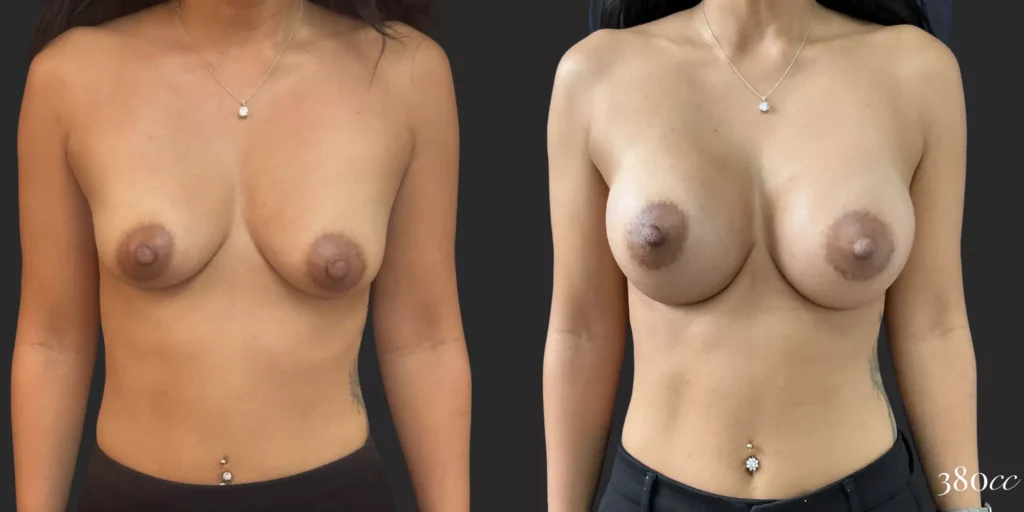 Breast Augmentation #014, before and after photo