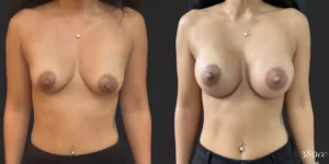 Breast Augmentation #014, before and after photo