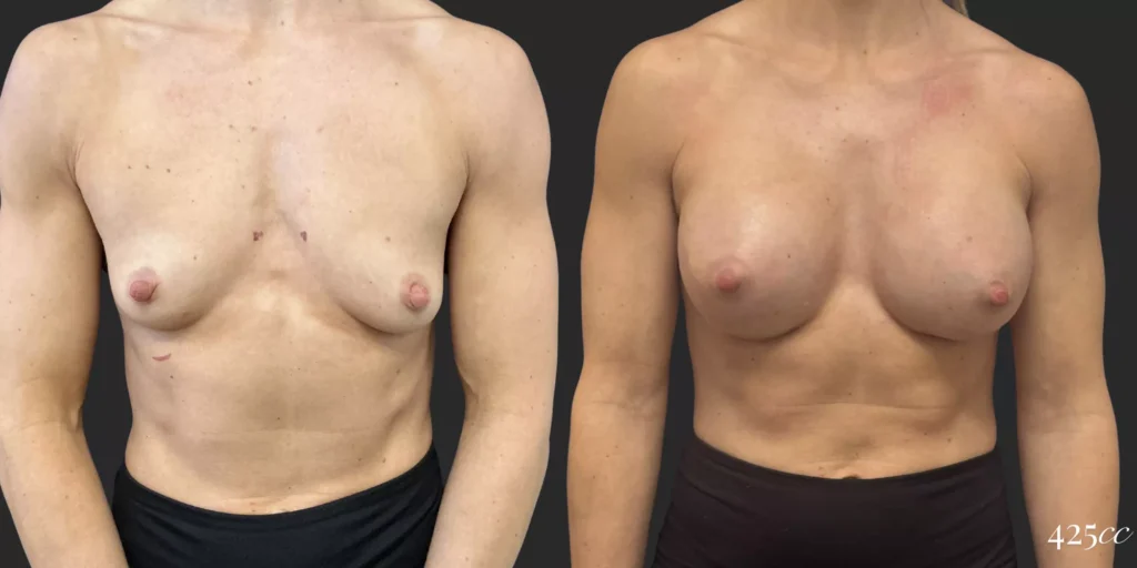 Breast Augmentation #015, before and after photo