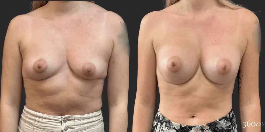 Breast Augmentation #017, before and after photo