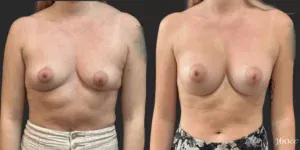Breast Augmentation #017, before and after photo