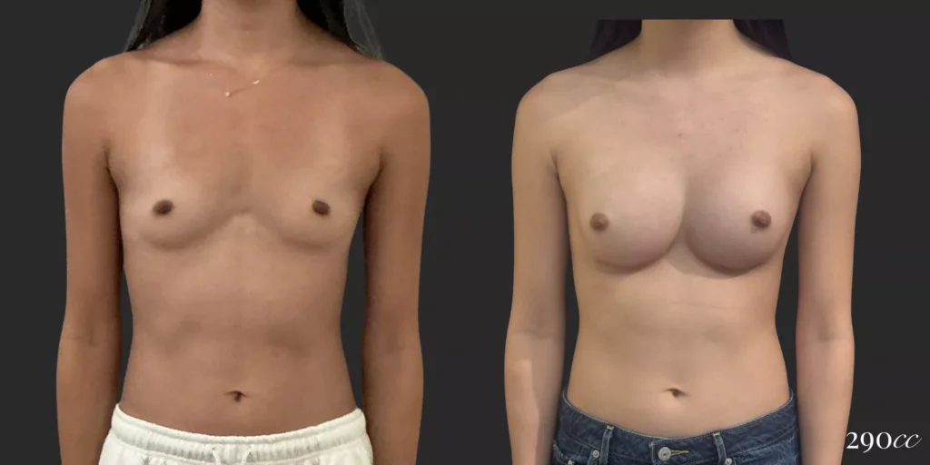 Breast Augmentation #019, before and after photo