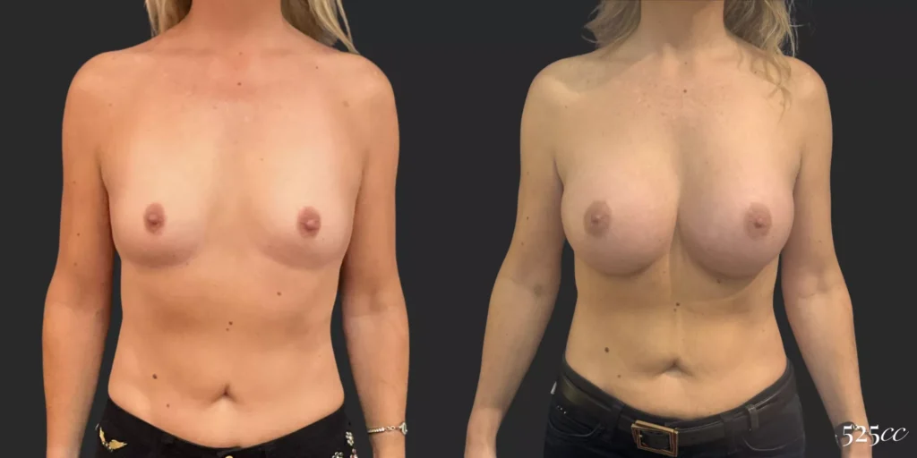 Breast Augmentation #020, before and after photo