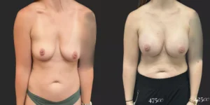 Breast Augmentation  #021, before and after photo