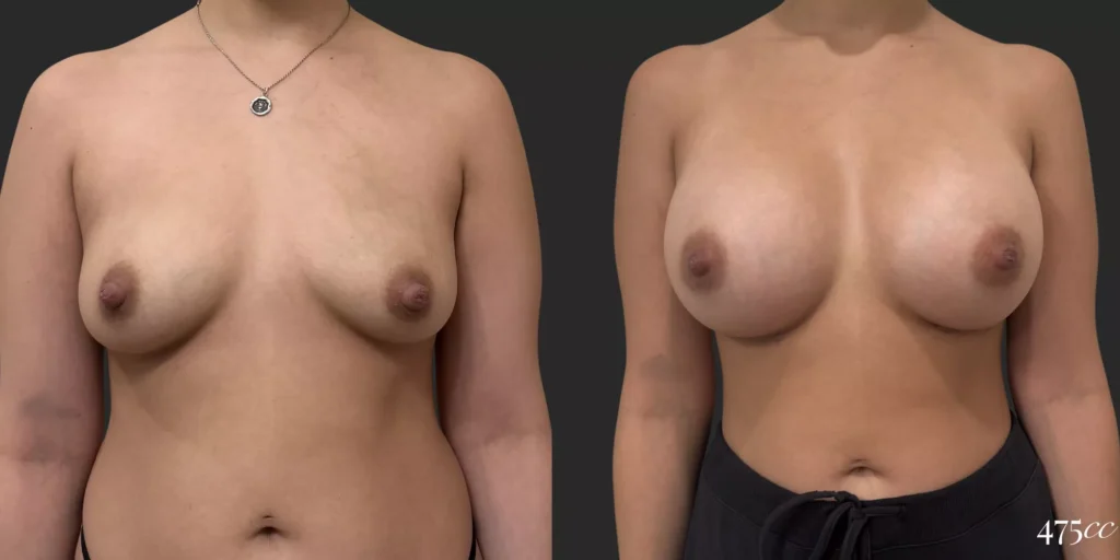 Breast Augmentation  #022, before and after photo