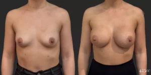 Breast Augmentation  #024, before and after photo