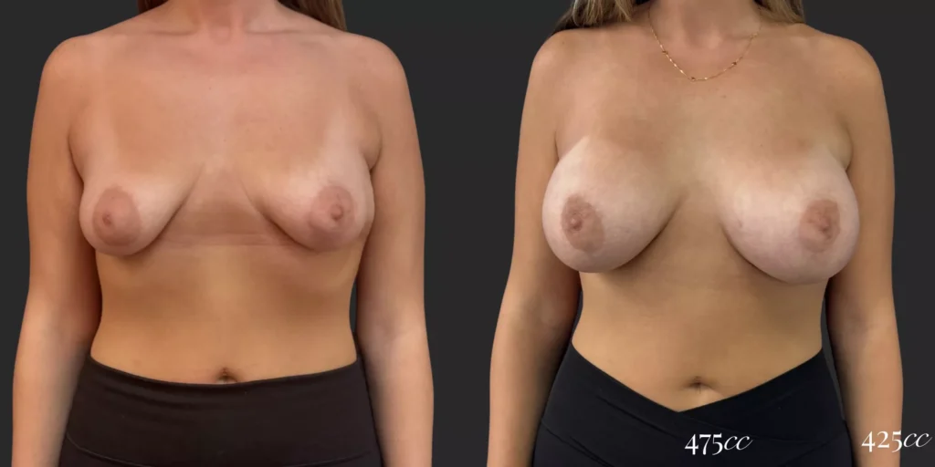 Breast Augmentation  #025, before and after photo
