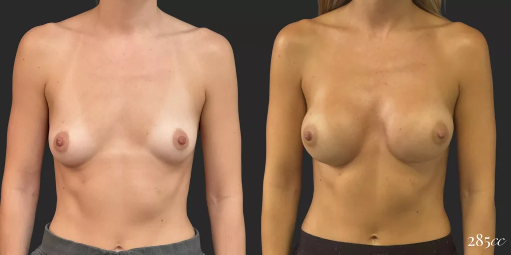 Breast Augmentation  #027, before and after photo