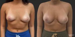 Breast Augmentation  #028, before and after photo