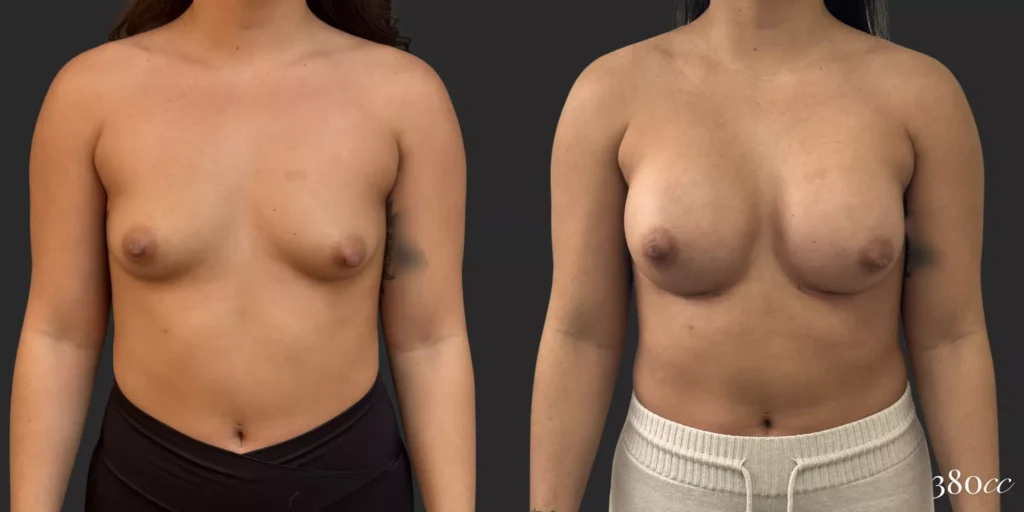 Breast Augmentation #029, before and after photo