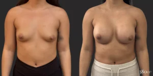 Breast Augmentation #029, before and after photo