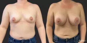 Breast Augmentation #031, before and after photo