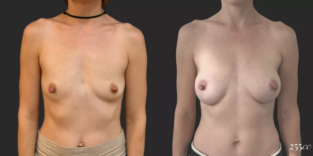 Breast Augmentation #038, before and after photo