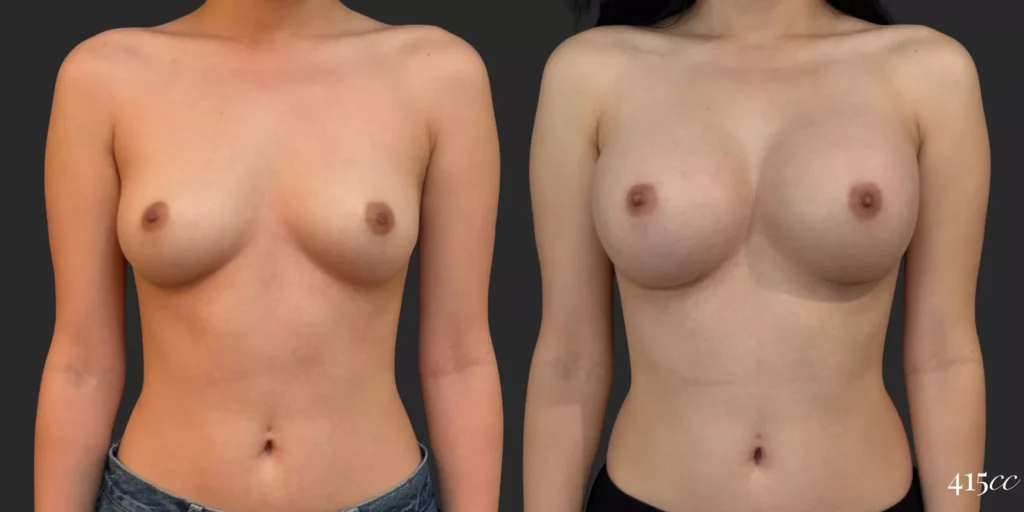 Breast Augmentation #039, before and after photo