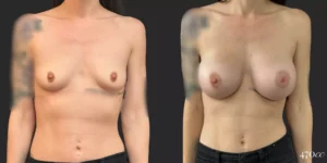 Breast Augmentation #042, before and after photo