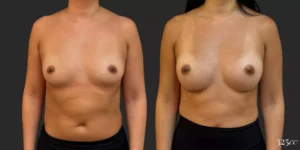 Breast Augmentation #045, before and after photo