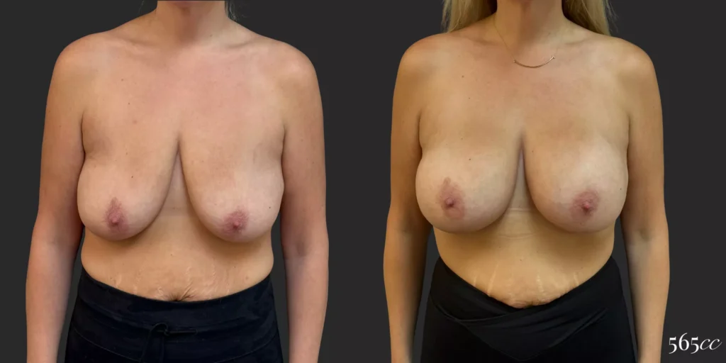 Breast Augmentation #046, before and after photo