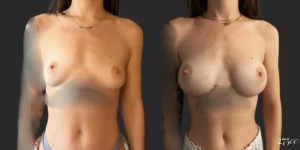 Breast Augmentation #048, before and after photo