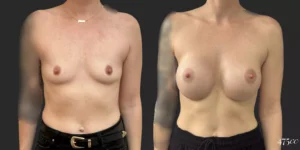 Breast Augmentation #049, before and after photo