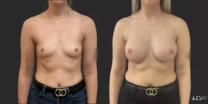 Breast Augmentation #050, before and after photo